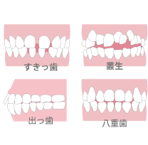 歯並びの種類